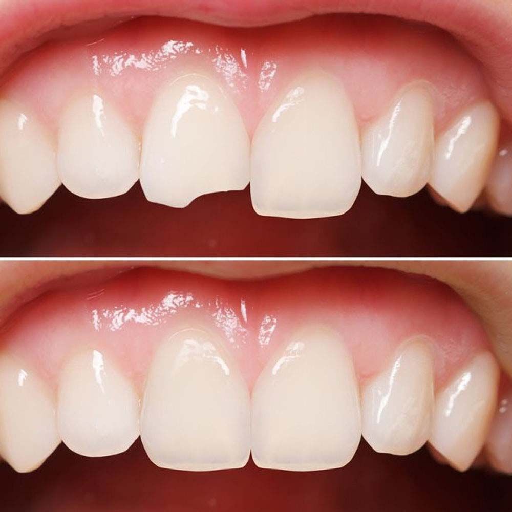 Tooth Restoration