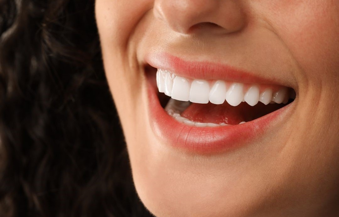 Teeth Whitening