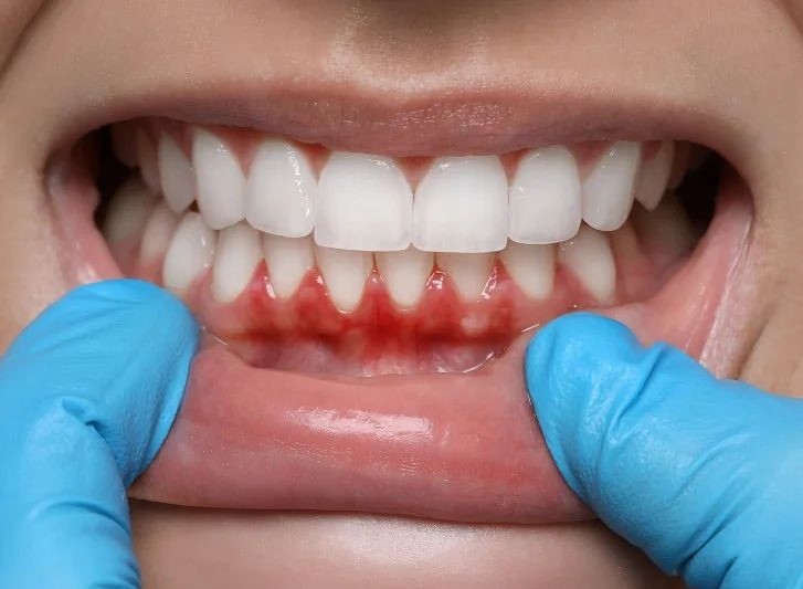 Gum Disease Treatment