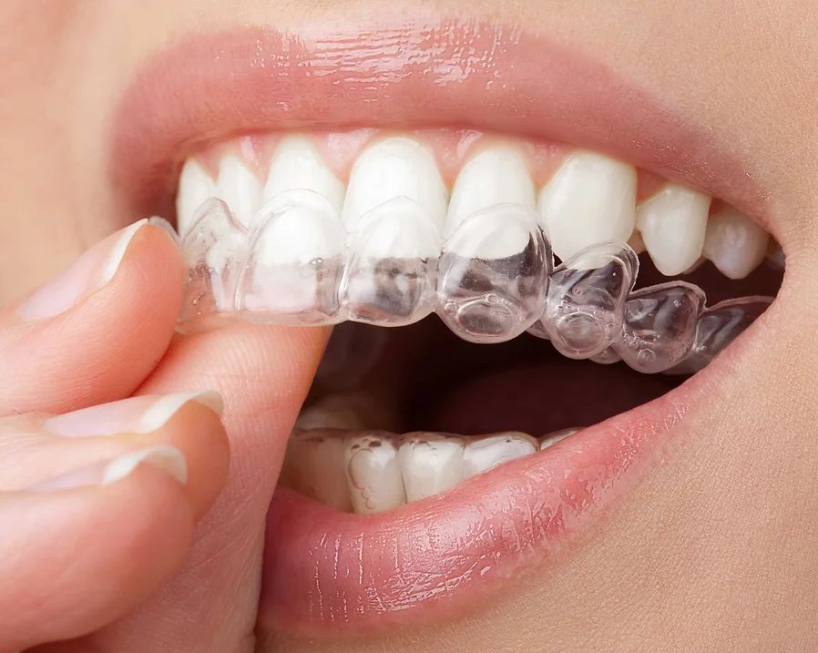 Smile Makeover Treatment