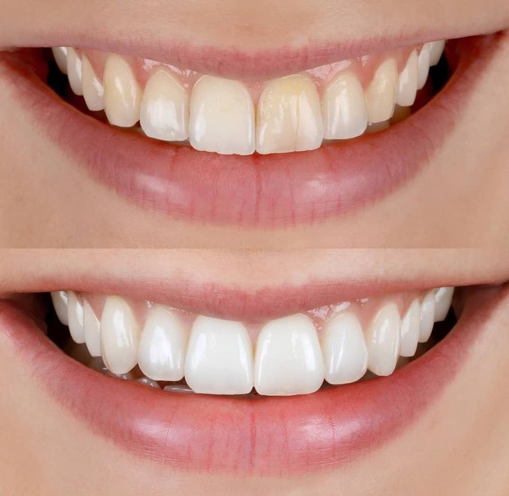 Smile Makeover