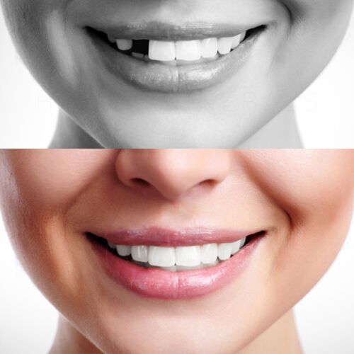 Tooth Restoration